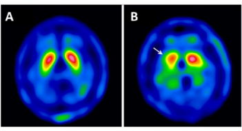 Parkinsonismos Medicamentoso